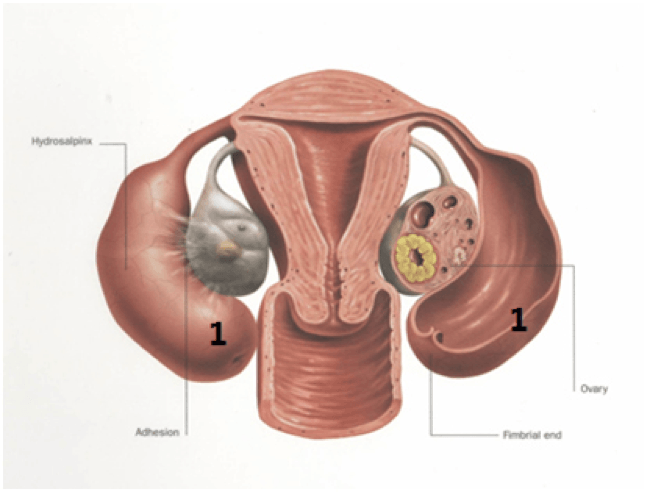 Diagram of a woman's reproductive system