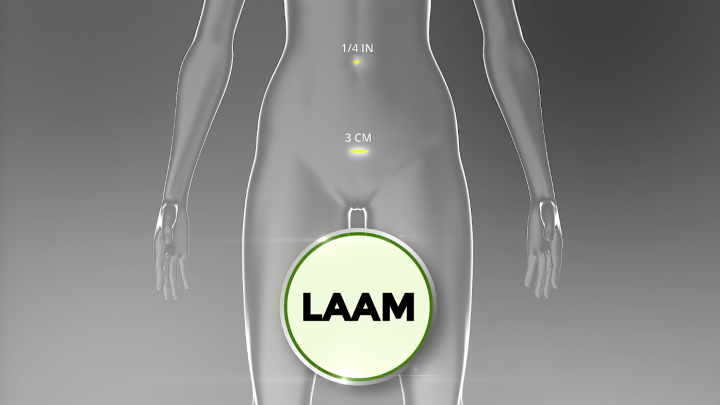 LAAM port illustration