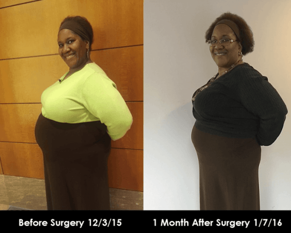 Before and after hysterectomy surgery comparison